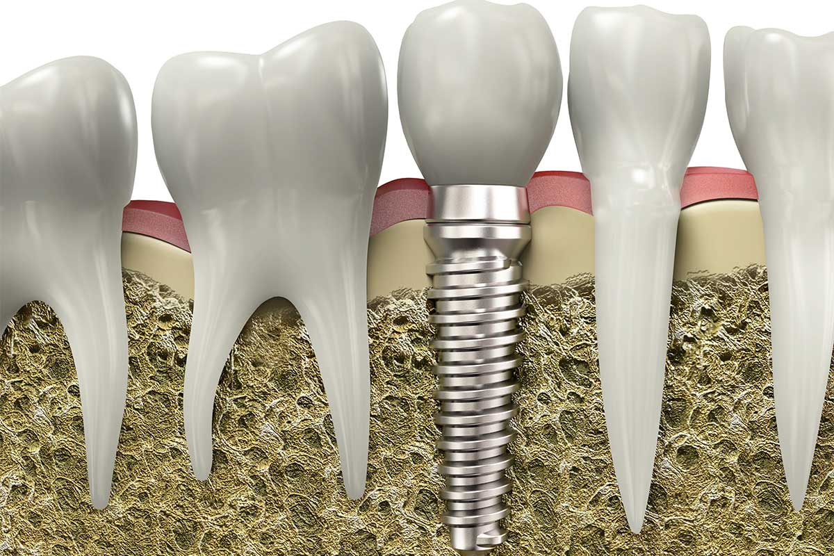 Dental implants cross view