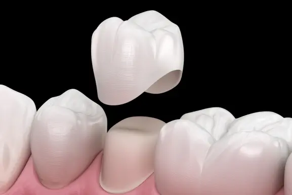 Dental bridge illustration showing a tooth-colored prosthetic spanning a gap between natural teeth.
