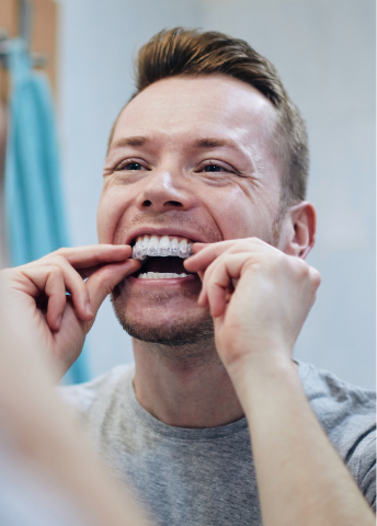 Man inserting clear Invisalign aligner trays into his teeth for orthodontic treatment.