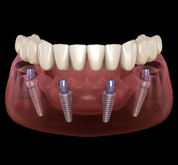 All-on-4 dental implant illustration showing prosthetic teeth supported by four implants in Orlando.