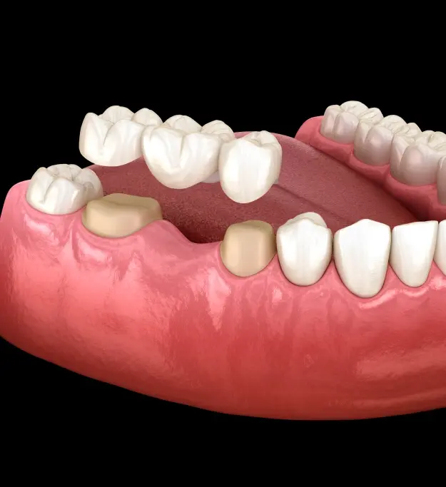 3D dental bridge illustration showing replacement teeth secured over gum ridge gaps.