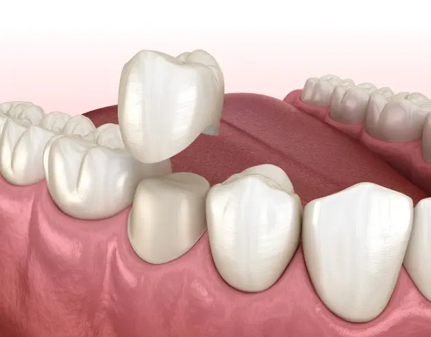 3D illustration of dental crown placement on upper premolar tooth in Orlando.