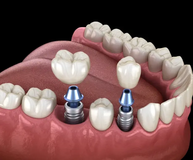 Dental implants with crowns replacing missing teeth in upper and lower jaw illustration.