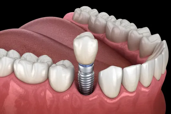 Dental implant illustration showing a screw-in implant with crown positioned among natural teeth.