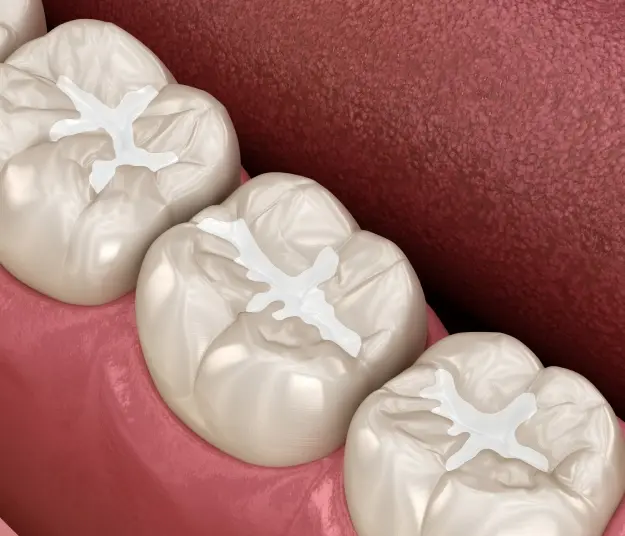 Three molars with white dental sealants applied to chewing surfaces on pink gum tissue.