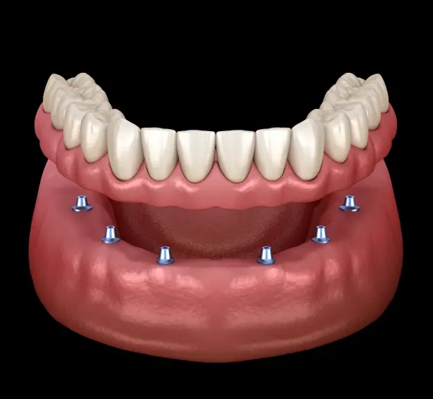 3D illustration of full mouth dental implant reconstruction with six implants anchoring a complete upper arch prosthesis.