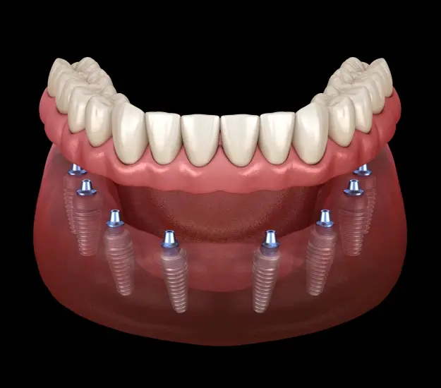 Dental implant supported dentures with blue abutments securing prosthetic teeth to jawbone.