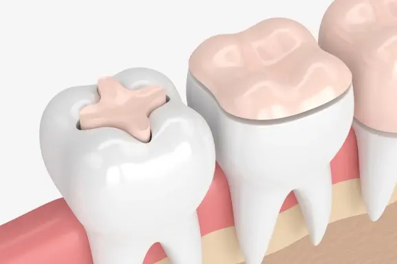 Illustration of tooth inlays and onlays showing restorative dental treatment options.