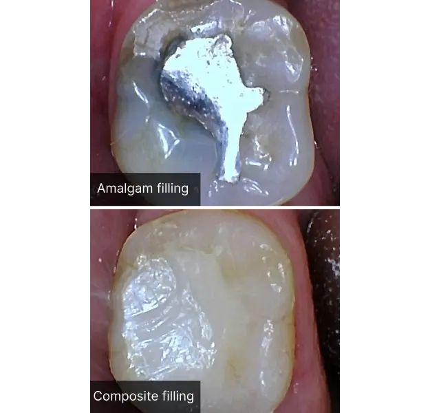 Comparison of amalgam and composite dental fillings on a posterior tooth.