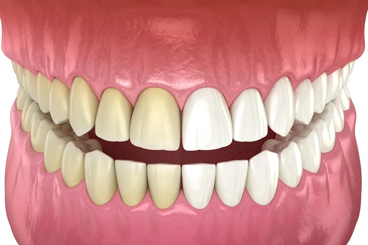Bright white teeth with natural shading showing results of professional whitening treatment.
