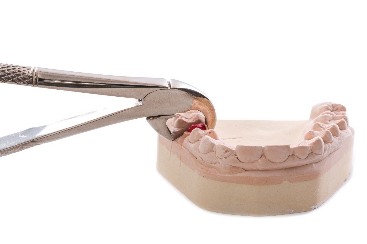 Dental forceps extracting tooth from anatomical model demonstrating post-extraction care.